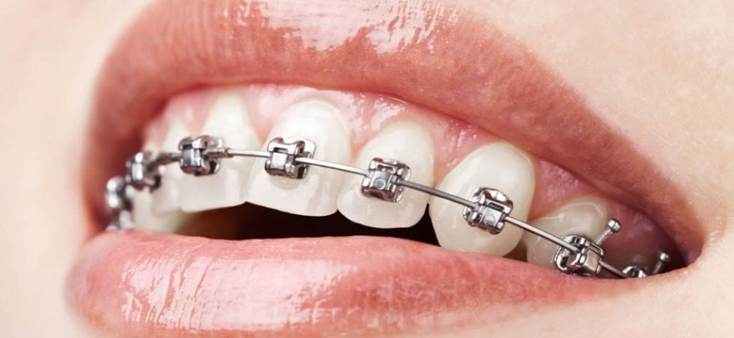 fixed braces concept medical negligence dental negligence client