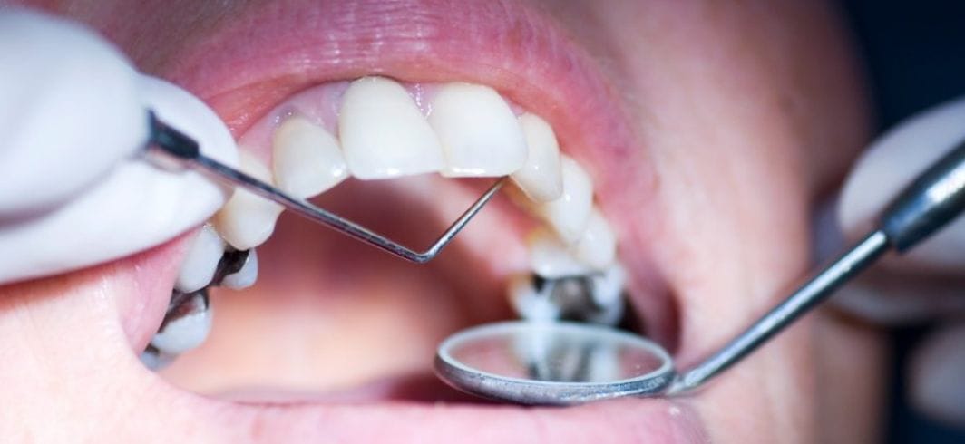 dental checkup close up of teeth being inspected concept medical negligence dental negligence client