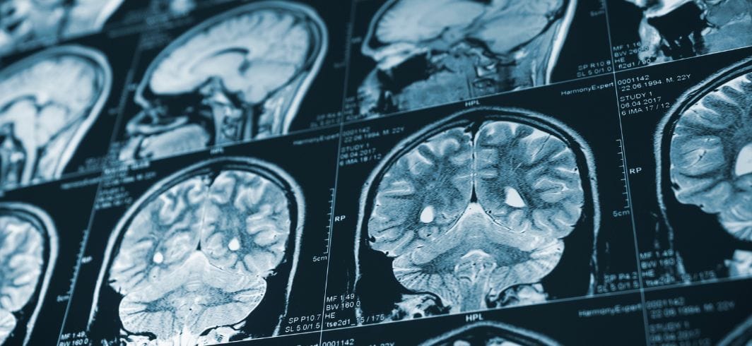 close up of head ct scans concept medical negligence hospital negligence client