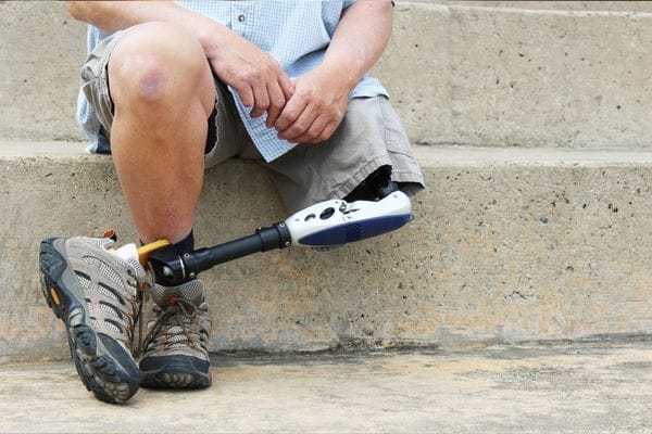 Man with prosthetic leg