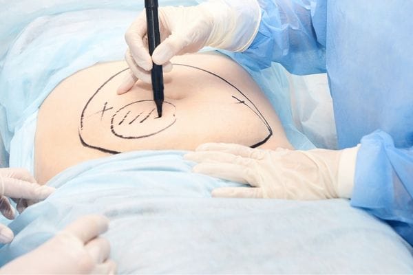patient undergoing liposuction cosmetic surgery