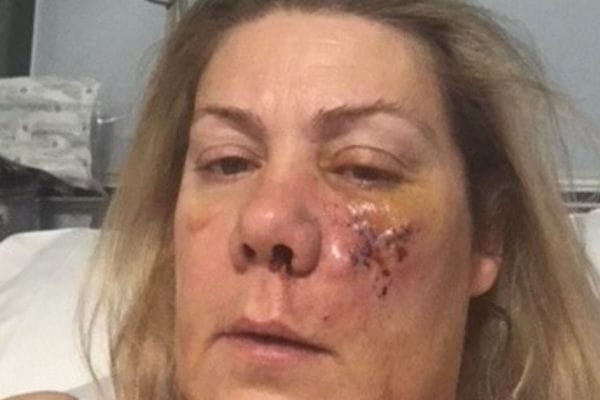 Lisa Bridgett in hospital after the manchester Arena terror attack