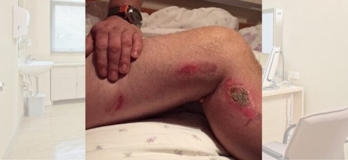 severe-leg-burns-when-gp-set-flammable-numbing-liquid-alight-during-skin-tag-removal-concept-clinical-negligence-burns-and-scald-compensation-680x313