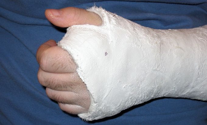 mans broken wrist in plaster cast concept medical negligence hospital negligence compensation claims feature image