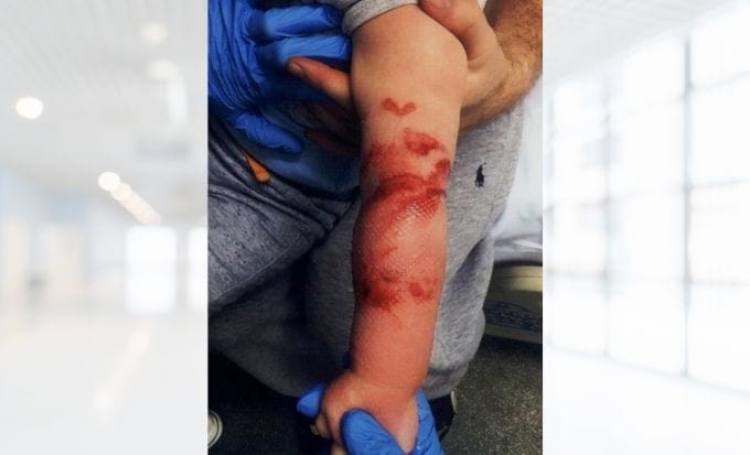 babys third degree burns on arm concept personal injury scalds and burns compensation feature