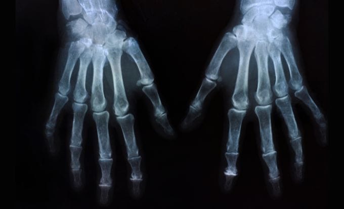 xray of two hands concept medical negligence hospital negligence feature