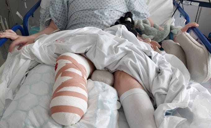 boy after having his leg amputated at great ormond street hospital concept medical negligence great ormond street hospital feature