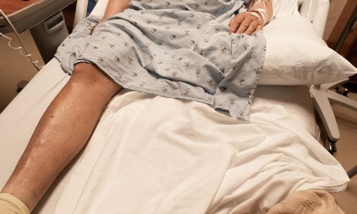 Single-leg-of-an-amputee-man-in-a-hospital-bed-concept-representing-medical-negligence-amputation-compensation-claims