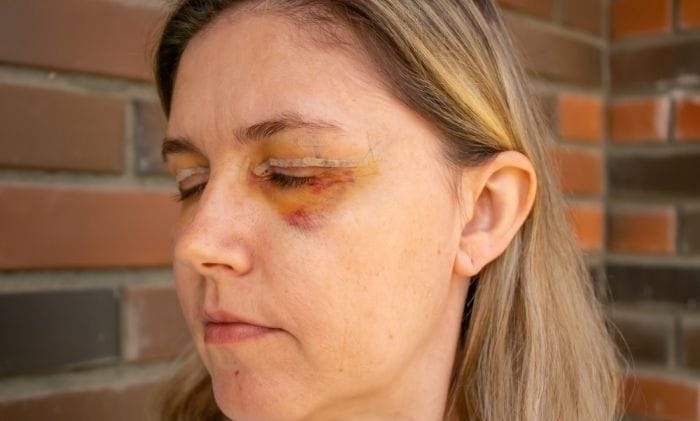 double eyelid surgery after plastic surgery concept representing medical negligence cosmetic surgery compensation claims
